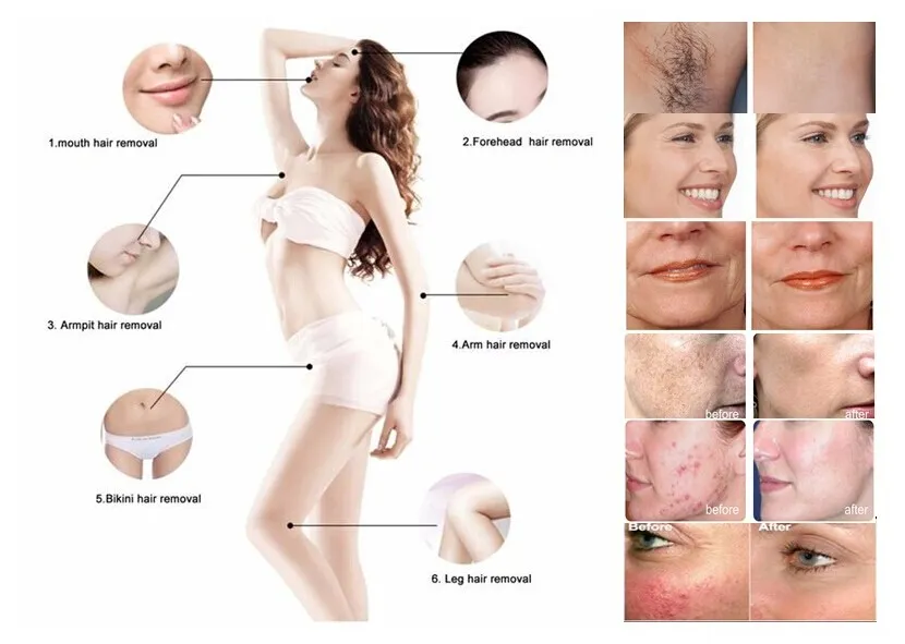 Epilador elétrico de remoção de pelos faciais IPL