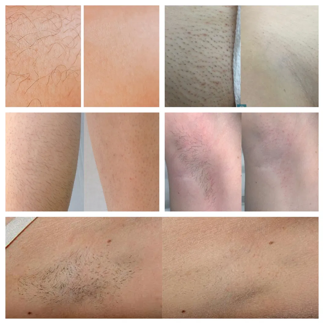 Antes e depois tratamento de pigmentação