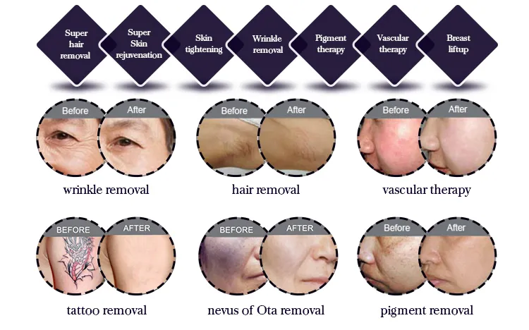 3 em 1 Dispositivo de Beleza IPL com Placa de Resfriamento no Japão para Remoção de Cabelo, Rejuvenescimento da Pele e Limpeza de Acne