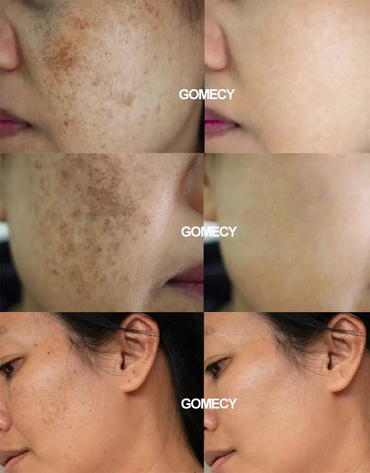 Máquina de Remoção de Pelos a Laser Permanente Luminel Super Hair Removal Opt Photon Rejuvenation da Lumenis Professional M22