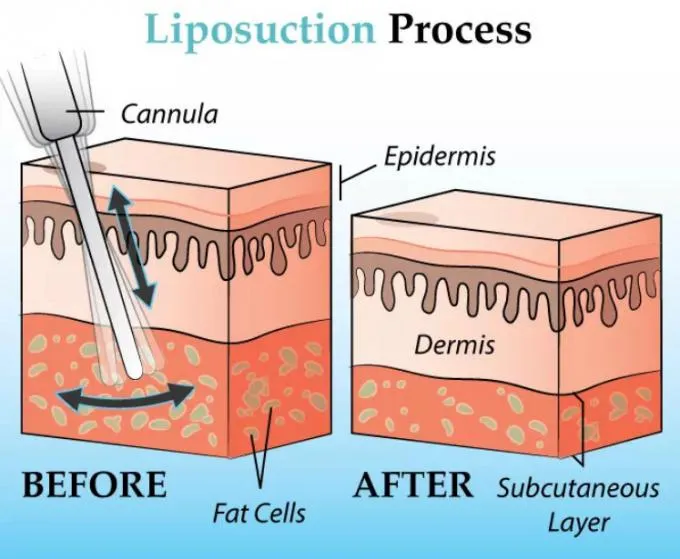 Dispositivo PAL para transplante capilar, centro de tratamento de acne, clínicas de cosméticos