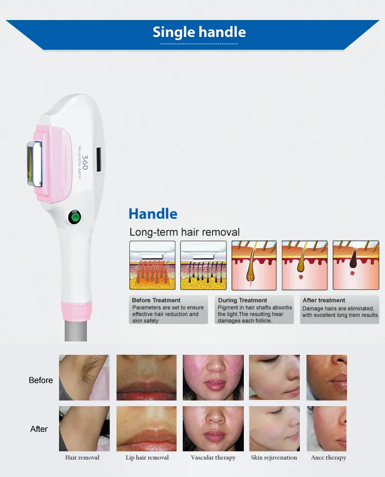Equipamento de Beleza IPL Opt Rápida Remoção de Cabelo IPL com IPL Elight SPA/Salao