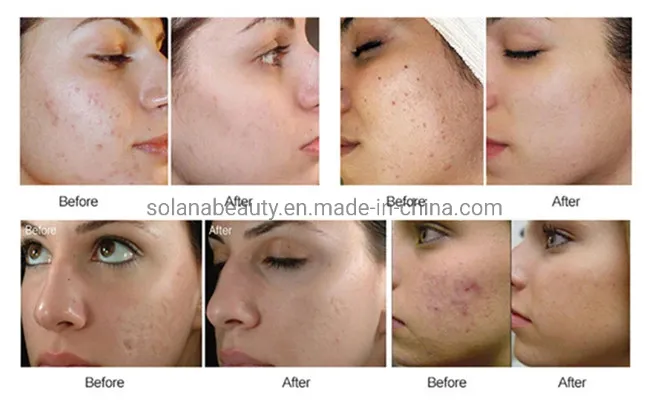 Resultado do Zgts Derma Roller
