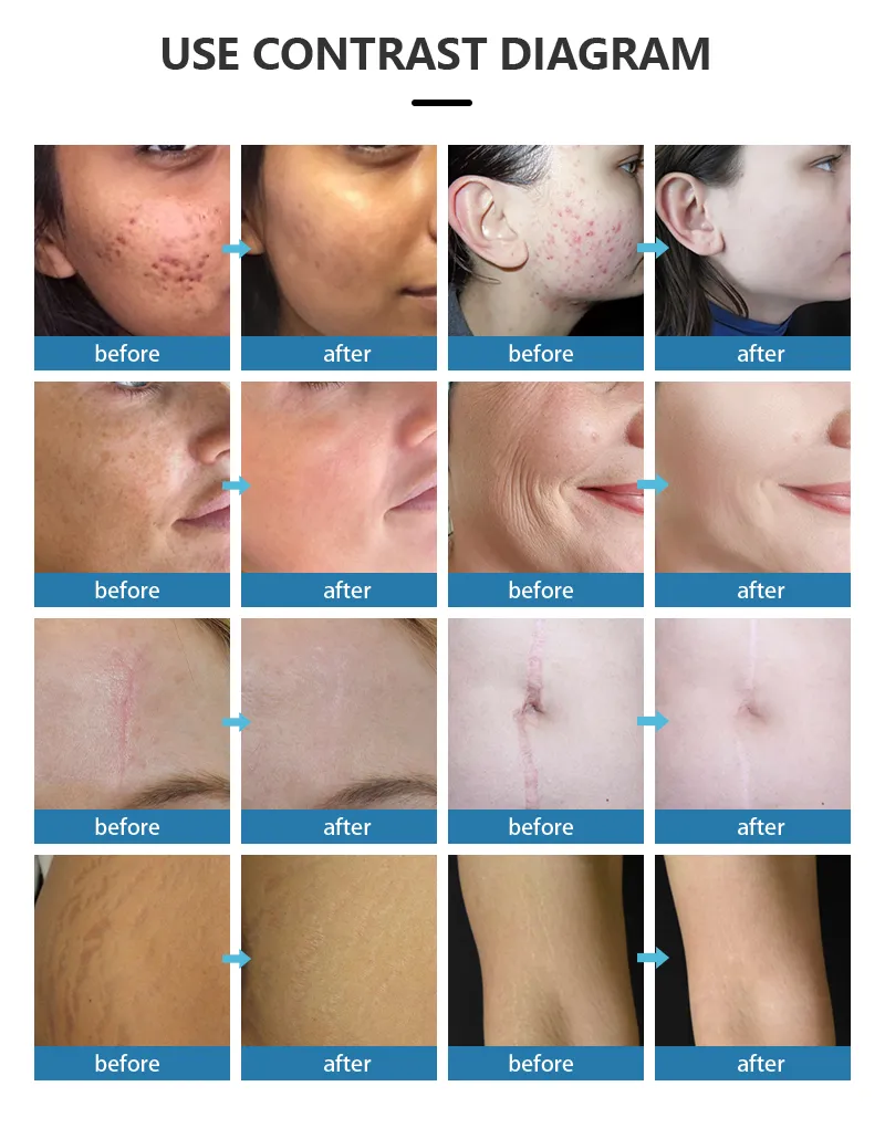 Máquina de Aperto Vaginal por Radiofrequência Preço de Fábrica Dispositivo de Aperto Vaginal por Radiofrequência