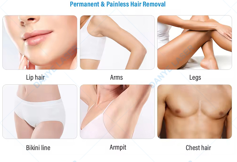 Dispositivo de Remoção de Pelo a Laser Diodo Personalizável para Centro de Beleza, Salão, Clínica
