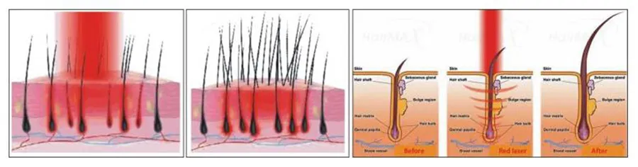 Dispositivo de Laser de Terapia Fotodinâmica Profissional Promove o Crescimento Capilar e Previne a Queda de Cabelo para Cabelos Mais Fortes e Saudáveis
