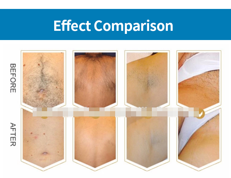 Envio Grátis 808nm Máquina Profissional Mini Diodo Laser de Titânio para Remoção de Pelos Corporais 3 Dispositivo de Onda Permanente CE Mulher