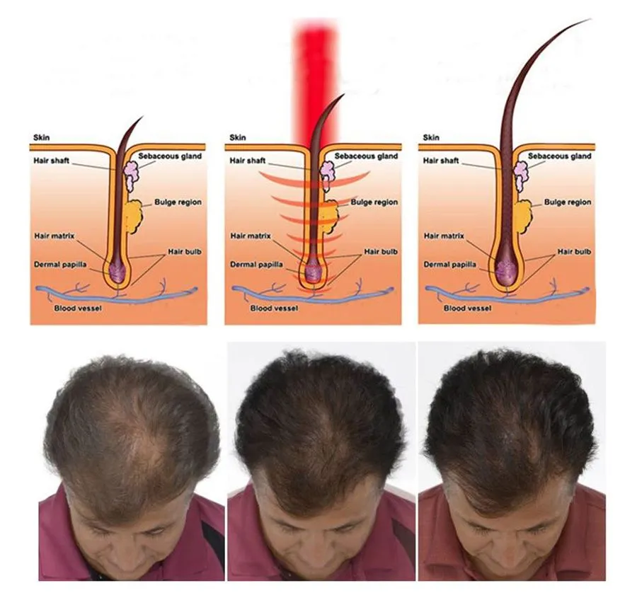 Resultados Antes e Depois do Tratamento Capilar a Laser