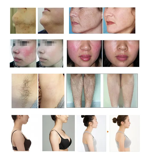 3 em 1 Dispositivo de Beleza IPL com Placa de Resfriamento no Japão para Remoção de Cabelo, Rejuvenescimento da Pele e Limpeza de Acne