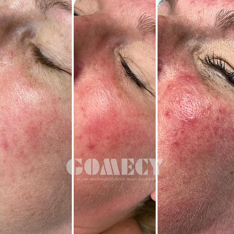 Antes e depois do rejuvenescimento facial