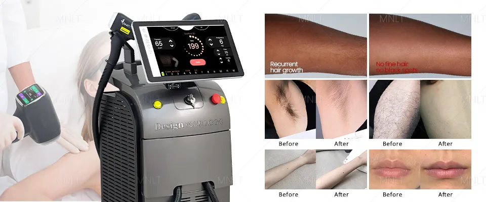 Diferentes comprimentos de onda de laser para remoção de pelos