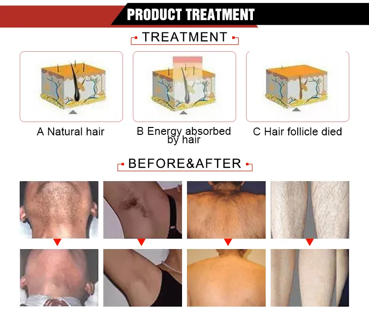 Epilador elétrico de remoção de pelos faciais IPL