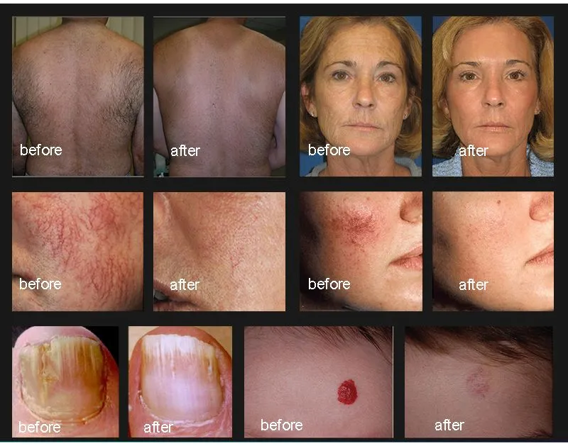 Dispositivo de Remoção de Pelo a Laser Alexandrite ND YAG Alex