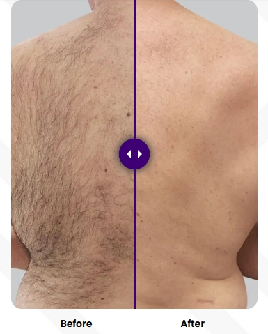 Fornecimento de Fábrica Dispositivo de Remoção de Cabelo de Alta Potência Rejuvenescimento da Pele Clareamento da Pele Cabo de Resfriamento 3wavelenths Dispositivo de Remoção de Cabelo a Laser de Diodo