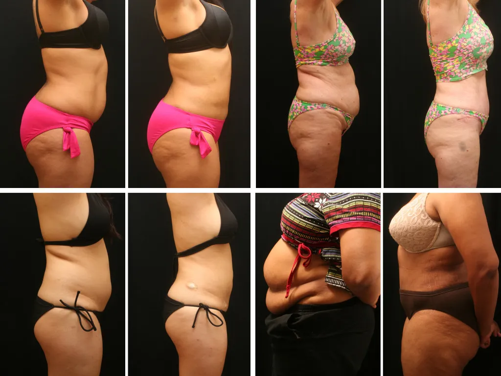Diagrama de Tratamento de Lipoaspiração