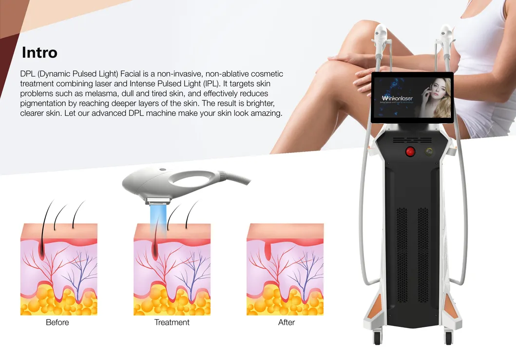 Dispositivo baseado em DPL para remoção de pelos, remoção de acne, rejuvenescimento da pele, remoção de veias emaranhadas
