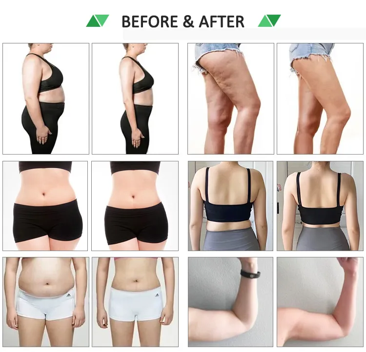 10d 532nm Dispositivo de Slimming a Laser para Redução de Celulite e Perda de Peso