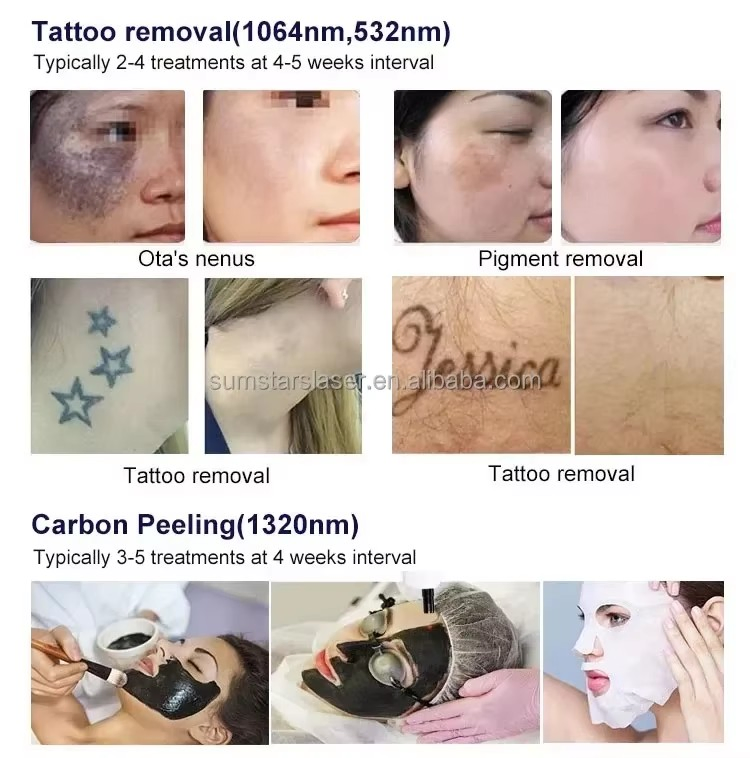 3-in-1 Máquina de Beleza a Laser IPL ND YAG para Remoção de Cabelo e Remoção de Tatuagem para Salão de Beleza