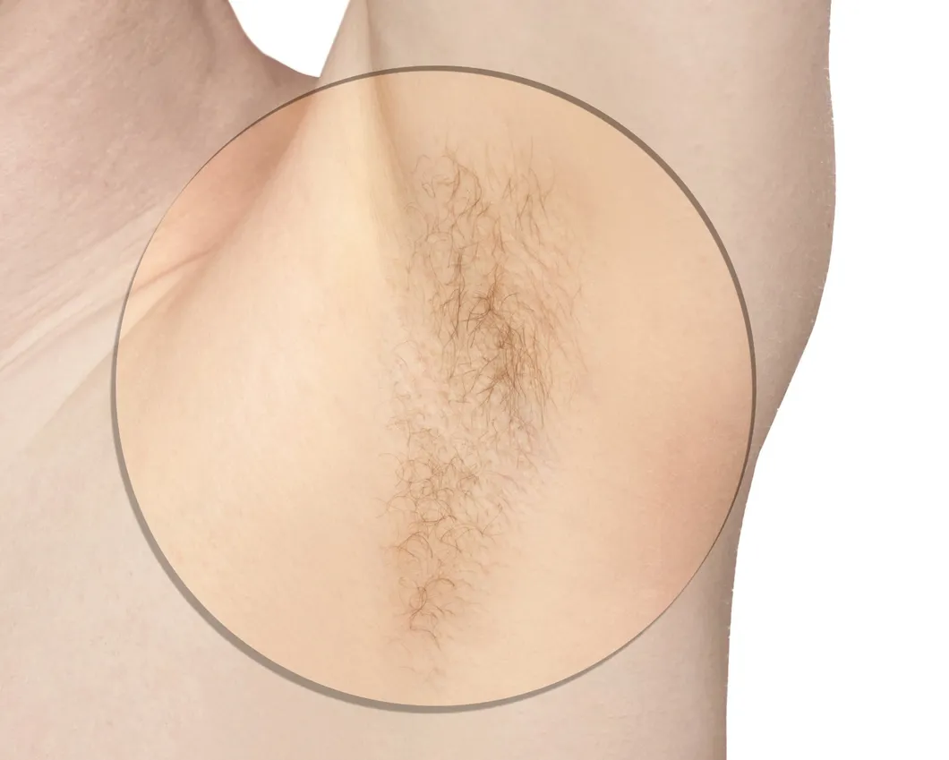 IPL SIFHR Remoção de pelos
