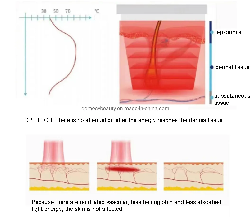 Dispositivo de Cuidados com a Pele Blacken Dpl para Pele Vascular e Redução de Marcas de Acne e Vermelhidão