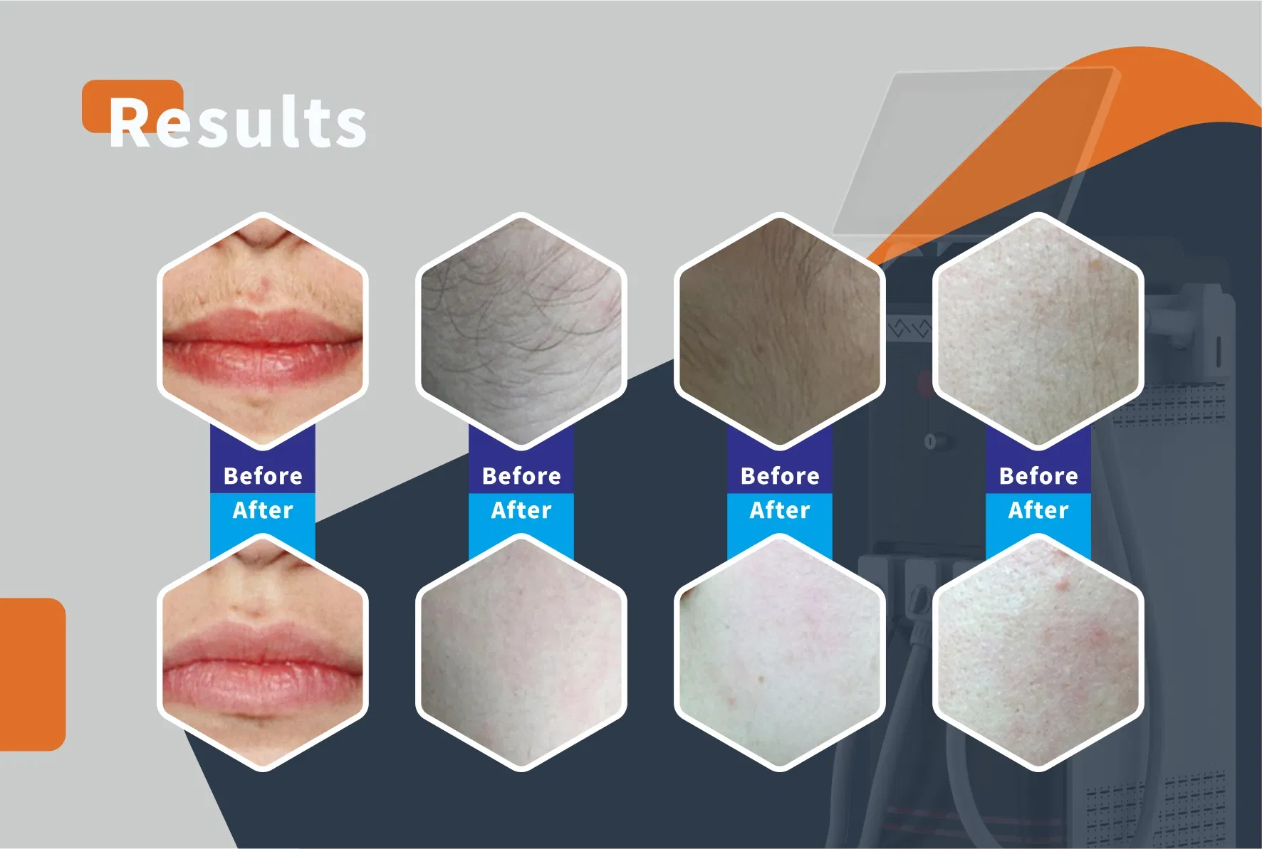 Máquina de Beleza a Laser IPL ND YAG 3-em-1