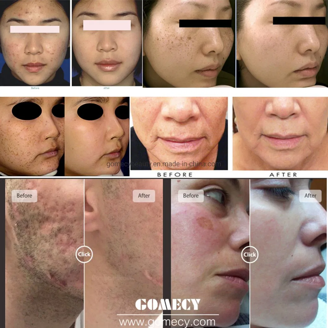 Dispositivo de Cuidados com a Pele Blacken Dpl para Pele Vascular e Redução de Marcas de Acne e Vermelhidão