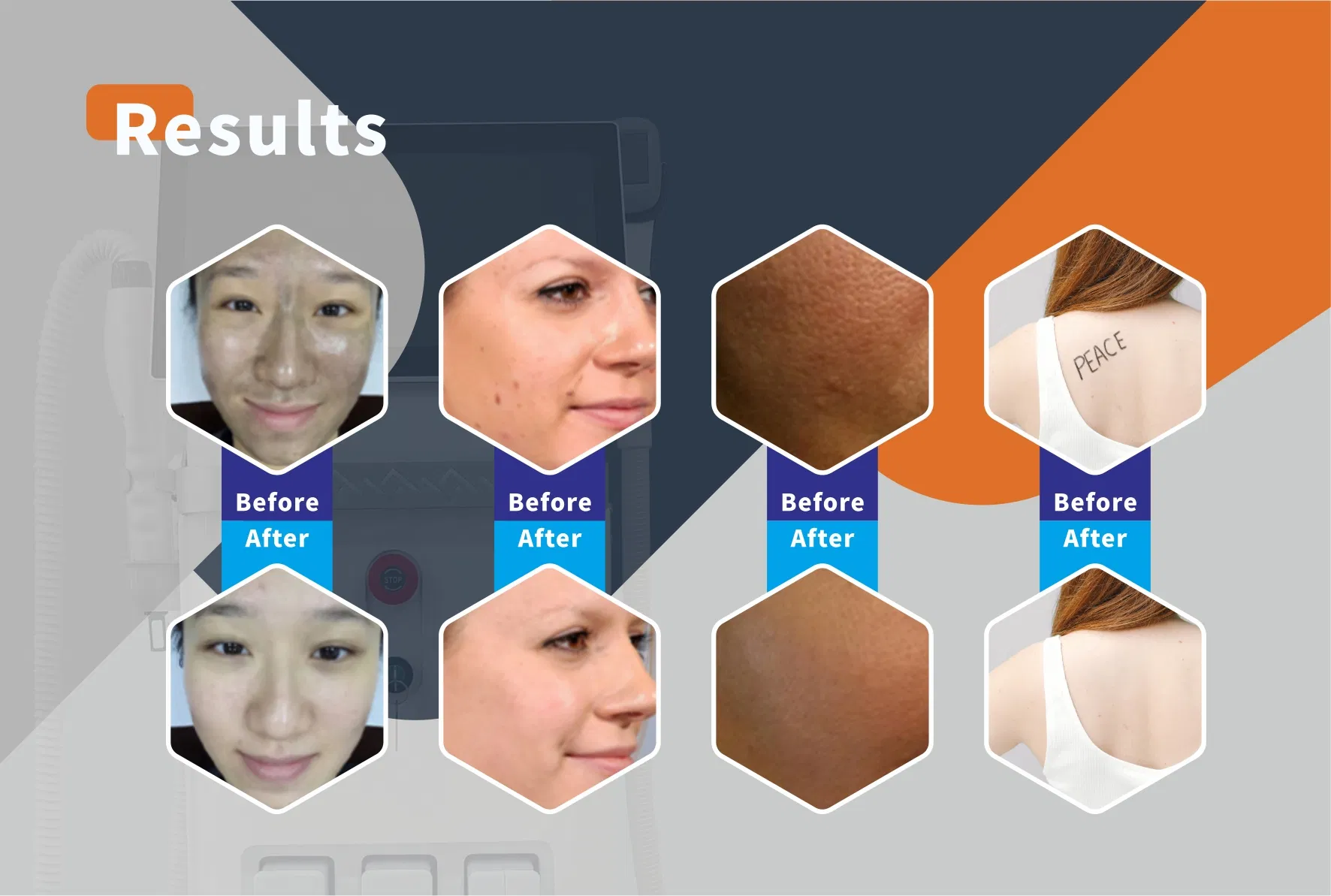 Máquina de Beleza a Laser IPL ND YAG 3-em-1