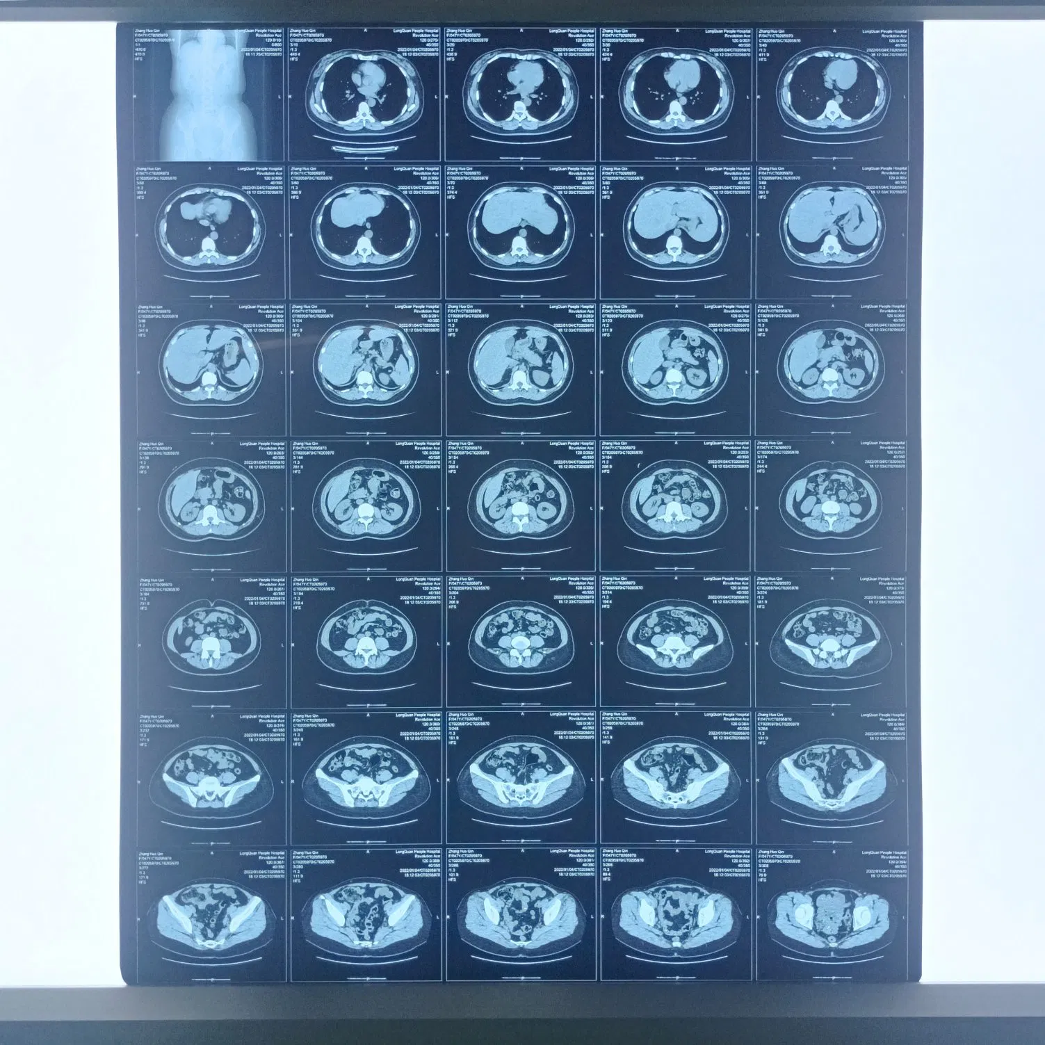 Filme a Laser Seco Médico Azul para Raios X 8*10 10*12 Alta Qualidade