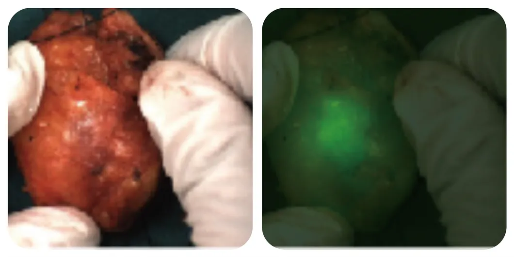 Tumor identification