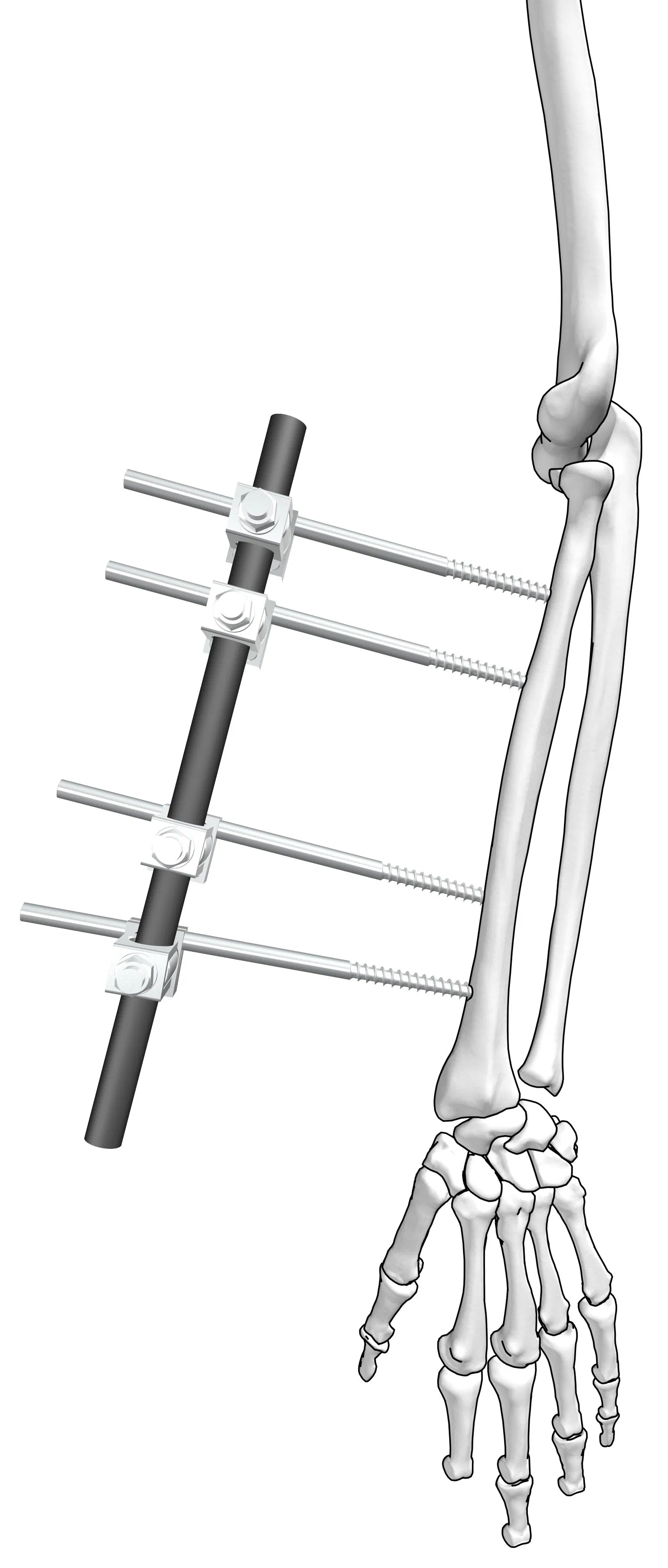 Orthopedic Trauma Implant Medical Device Dissection IV (Φ 5) Distal Radius External Fixation
