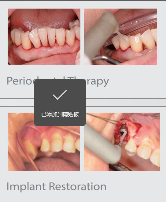 Blackstone Er YAG Dental Laser Instrument for Dental