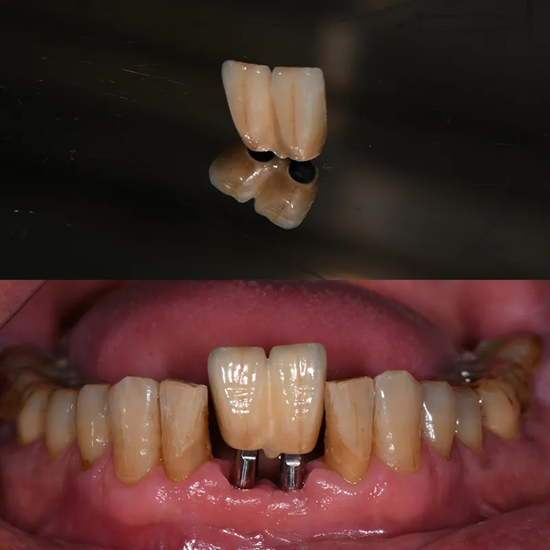 Dental Implant Supplies