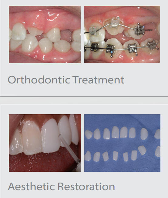 Blackstone Er YAG Dental Laser Instrument for Dental