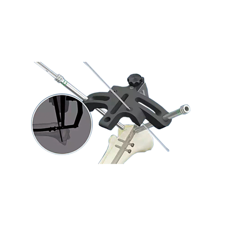 Orthopedic Medical External Fixation Support Peek Tibial Proximal Nail Target Device