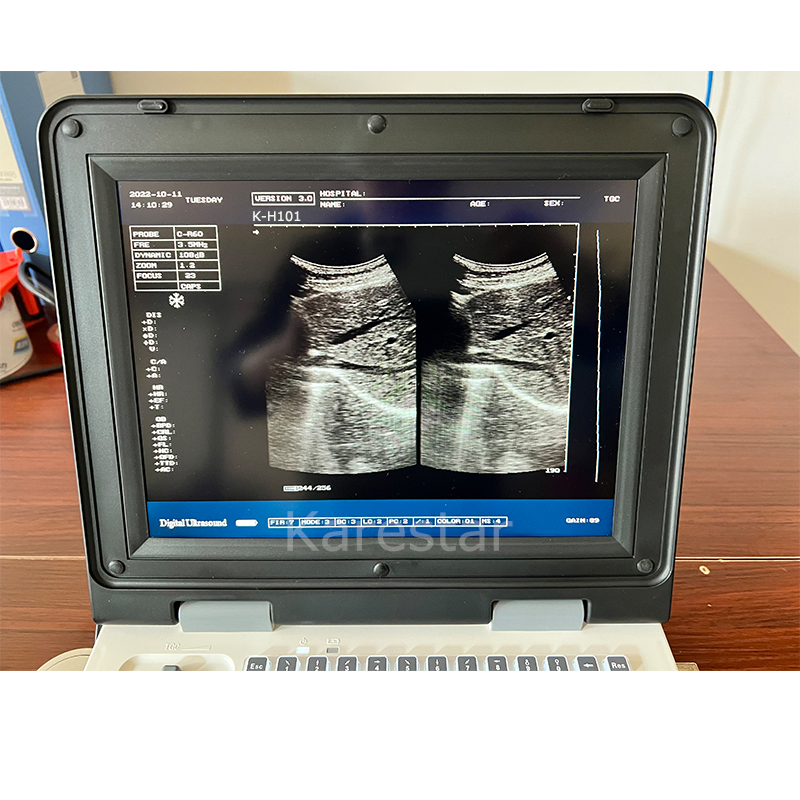 Laptop Echo Scanner Human Being Ultrasound Devices Portable with Low Price