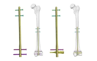 Femoral Nail 1