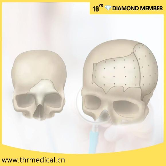Neurosurgery Peek Patient Specific Implant Custom Maxillofacial Repair System