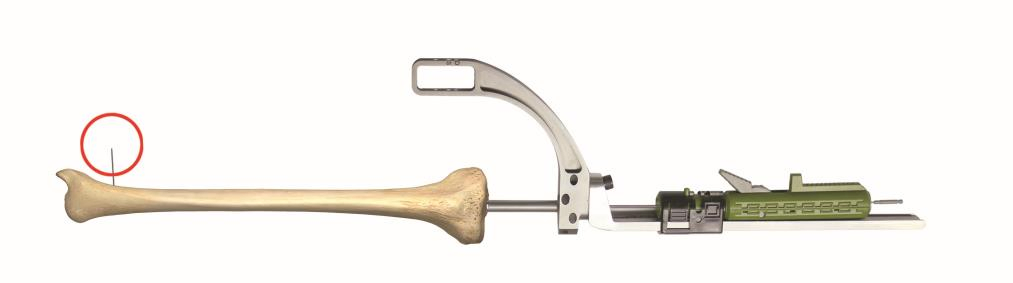 Gustilo Revdrill and Controller, Femoral Intramedullary Nail
