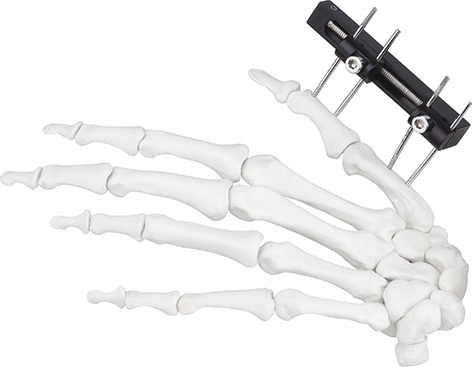 External Fixator Hand Bone Pin Stent Radius Mini Fixator Universal Compression Extension Type