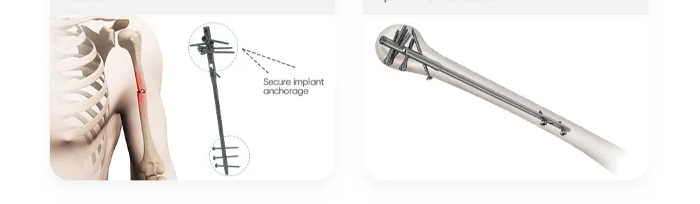 Advantages of Humerus Nail