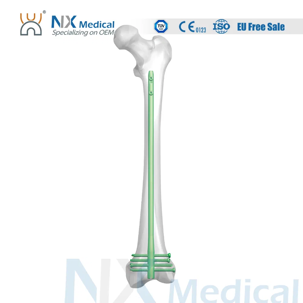 Nx Medical Orthopedic Retrograde Femoral Intramedullary Interlocking Nail System for Trauma Implant