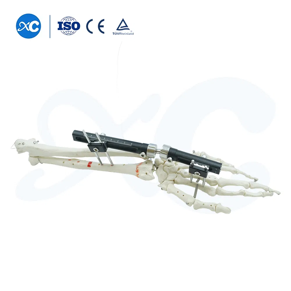 Factory Direct Supply Orthopaedic External Fixation Device, Ulna &amp; Radius External Fixator OEM ODM