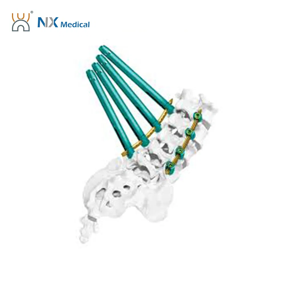 Nx Medical Orthopedic Implant Spine Cannulated Bone Cement Pedicle Screw Spinal Fixation