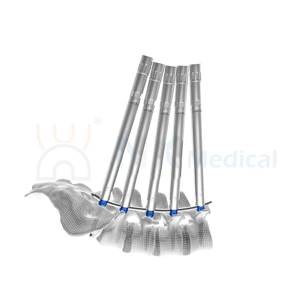 Nx Medical Titanium Cannulated Bone Cement Spinal Pedicle Screw Spine Internal Fixation