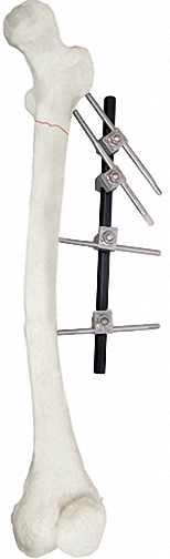 External Fixator, White &amp; Black, for Bone Fixation, Titanium Alloy &amp; Steel
