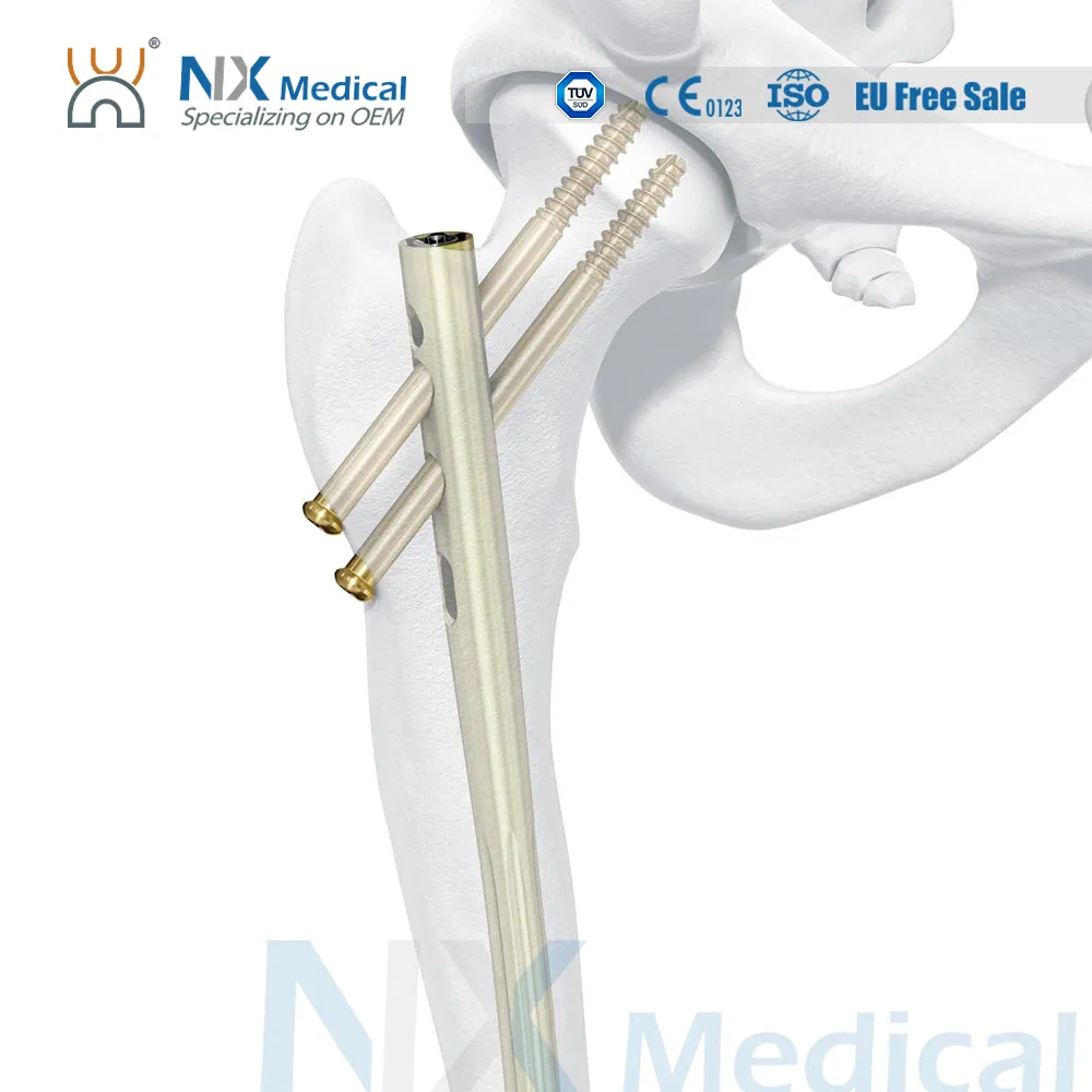 Nx Medical Interlocking Intramedullary Femoral Nail Titanium Orthopedic Implants