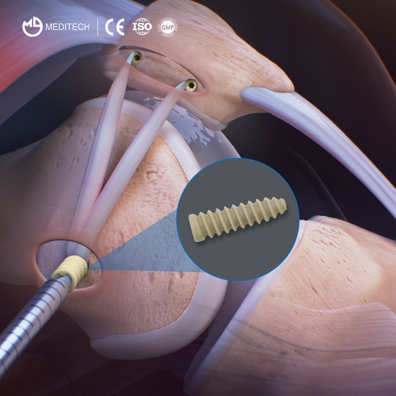 Sports Medicine Tibial Ligament Reconstruction Implants Peek Interference Screw