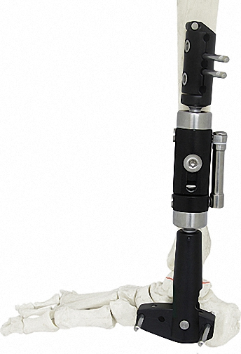 External Fixator, White &amp; Black, for Bone Fixation, Titanium Alloy &amp; Steel