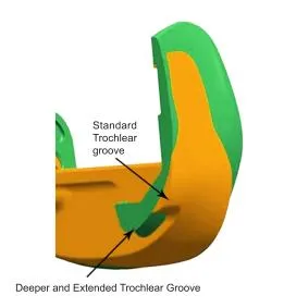 Extended Trochlear Groove Diagram