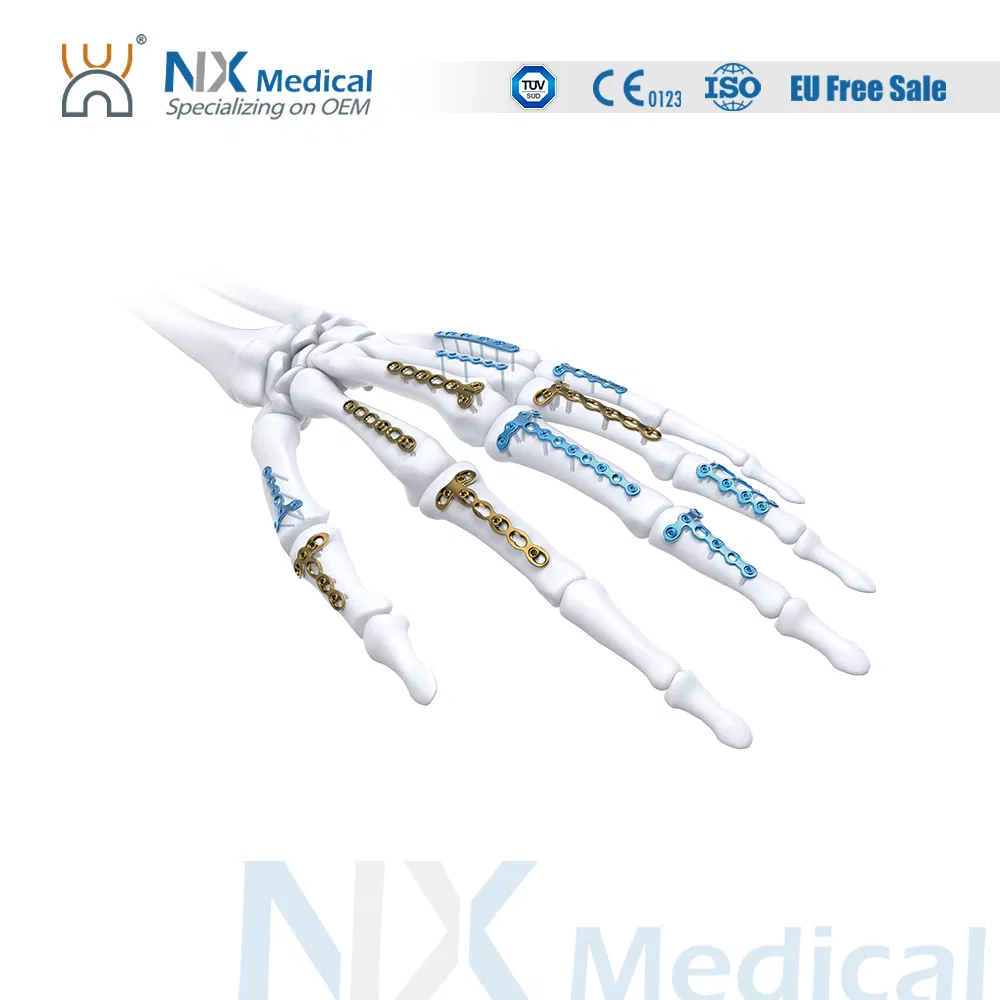 Nx Medical Variable Angle Locking System Mini Fragment Compression Titanium Plate